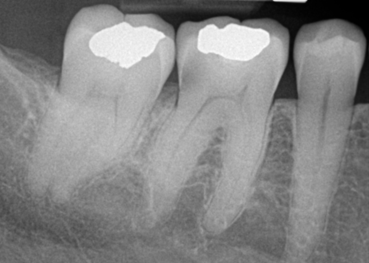 Dental Xrays–What Value Do You Place On Your Dental Health?