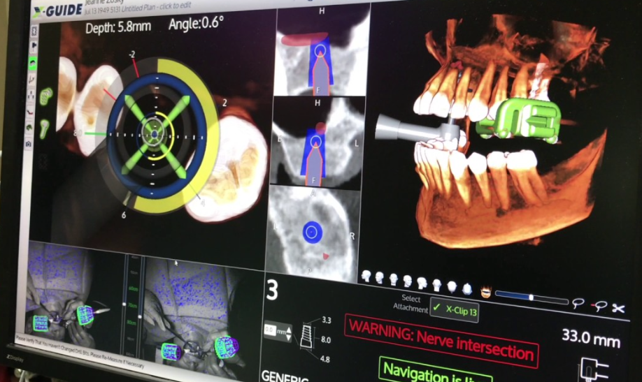 X-Guide Aids in Innovative Precision for Implant Procedures
