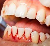Healthy Gums Don’t Bleed!