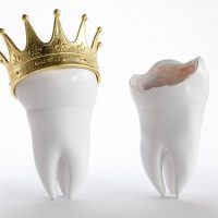 What Are Dental Crowns?