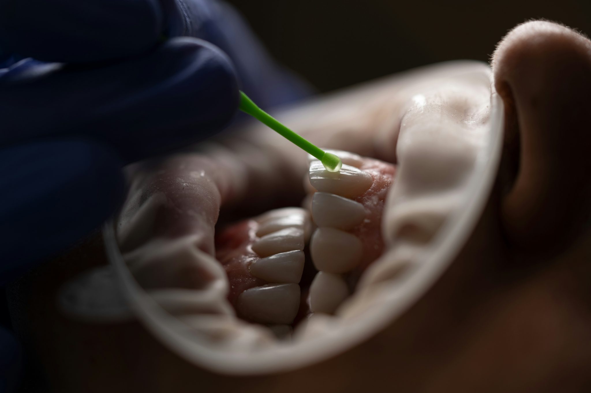 The Importance of Fluoride Varnish in Dental Care